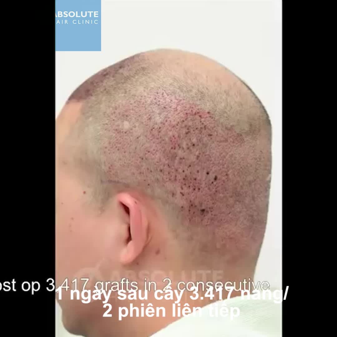 Nhật ký cấy tóc từ khi bắt đầu đến 9 tháng