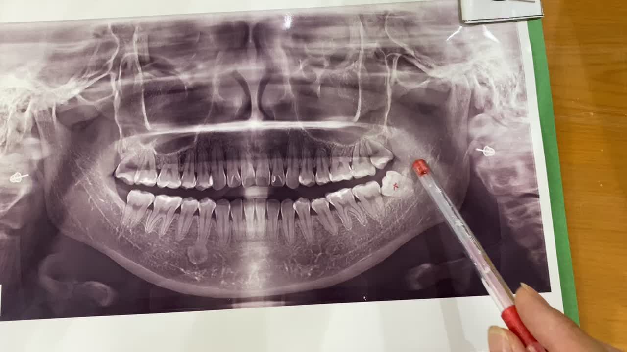 Nhổ răng khôn số 38 bị lợi trùm viêm đau cho bạn khách hàng tại Nha Khoa Thuỳ Anh.