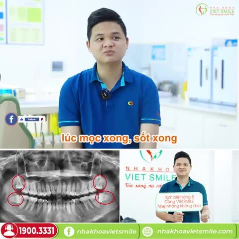 RĂNG KHÔN MỌC GÂY SỐT, KHÓ CHỊU - QUYẾT ĐỊNH ĐI NHỔ SỚM