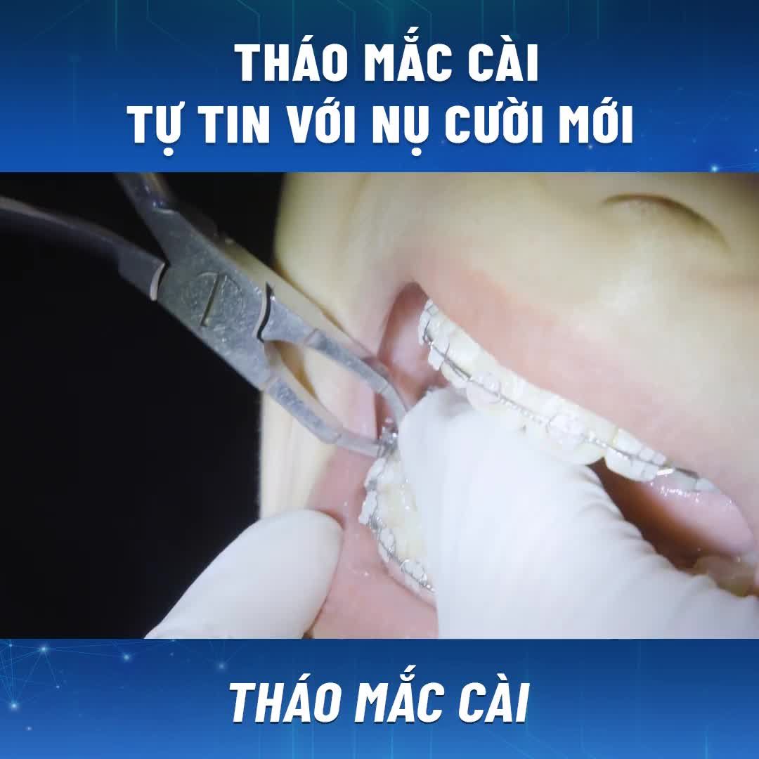 THÁO MẮC CÀI TỰ TIN VỚI NỤ CƯỜI MỚI