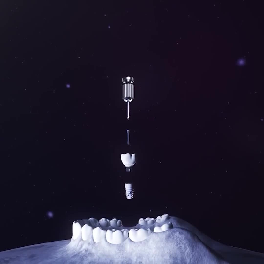 TRỤ IMPLANT NOBEL BIOCARE KẾT HỢP ROBOT X-GUIDE KẾT QUẢ TỐI ƯU TRỌN ĐỜI