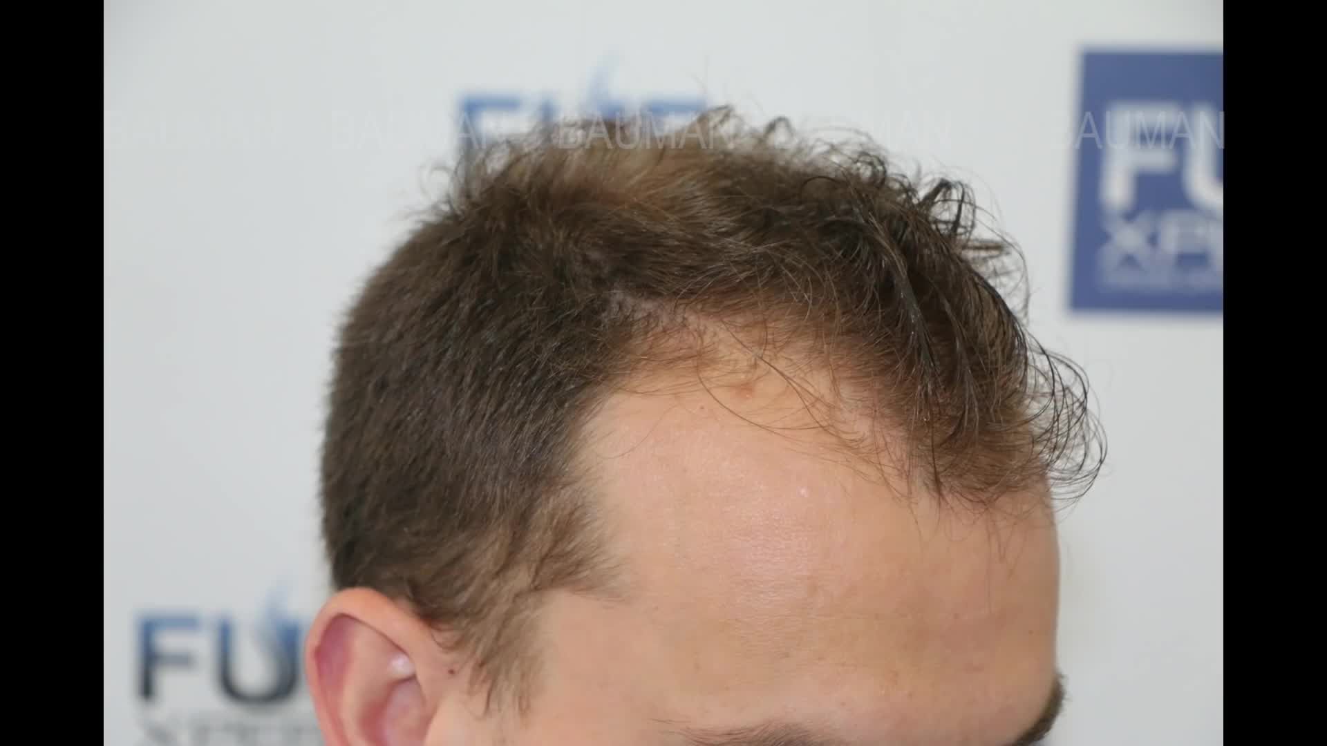 Cấy tóc FUE 3052 nang tóc trị hói đầu vùng trán và đỉnh