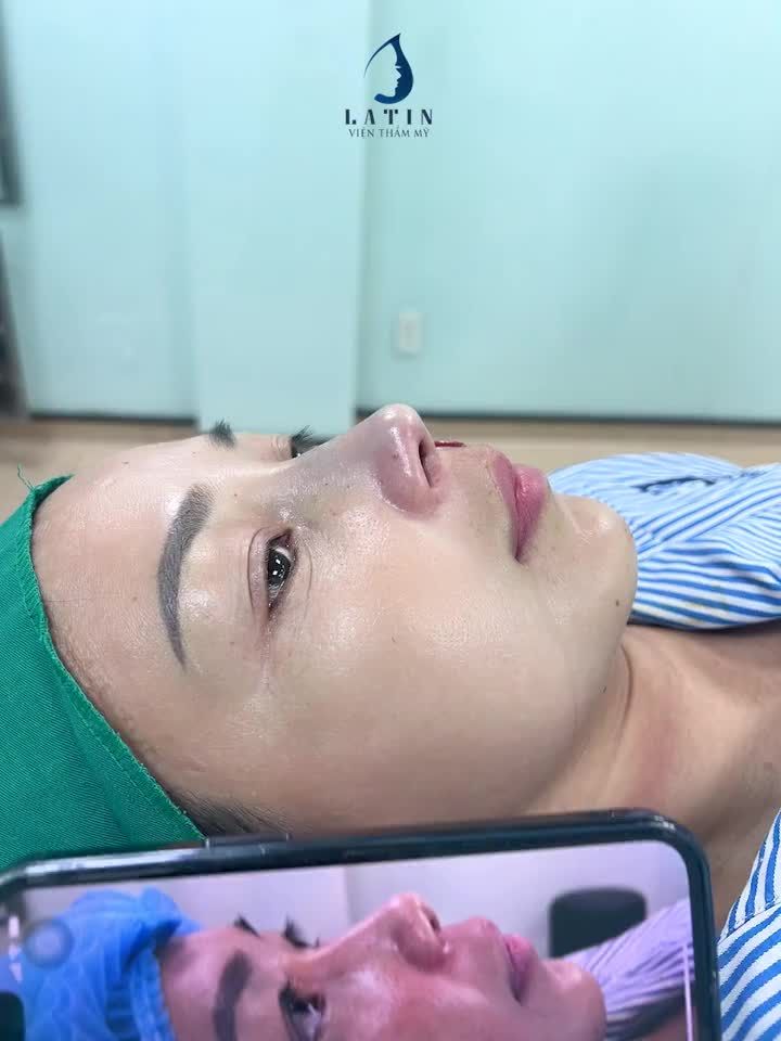Mũi đẹp ngay sau phẫu thuật, tại sao không