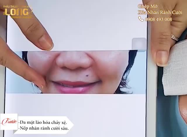 ẤP ĐẦY NẾP NHĂN - DA SĂN TRẺ HÓA