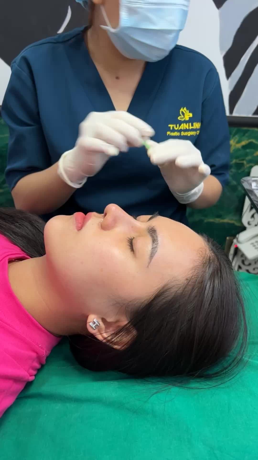 Case mũi cấu trúc surgiform 1 tháng sẽ như thế nào