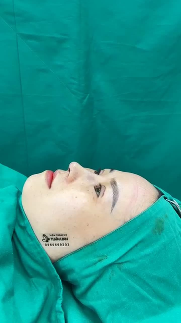 Case Nâng mũi cấu trúc + sụn surgiform + bọc megaderm đầu mũi + cắt mí vừa hoàn thành