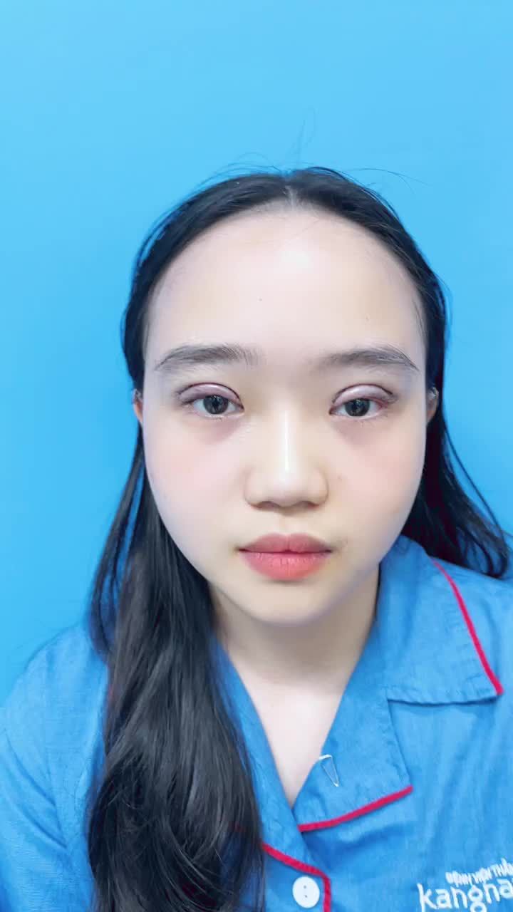 Nhân dịp Sinh nhật 10 năm Chuyên khoa Mắt Mũi - Nữ khách hàng tại Hà Nội tranh thủ tới Kangnam sắm ngay chiếc mí xinh xắn