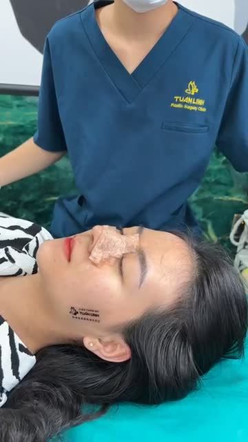Cận cảnh dáng mũi sau 10 ngày nâng mũi cấu trúc