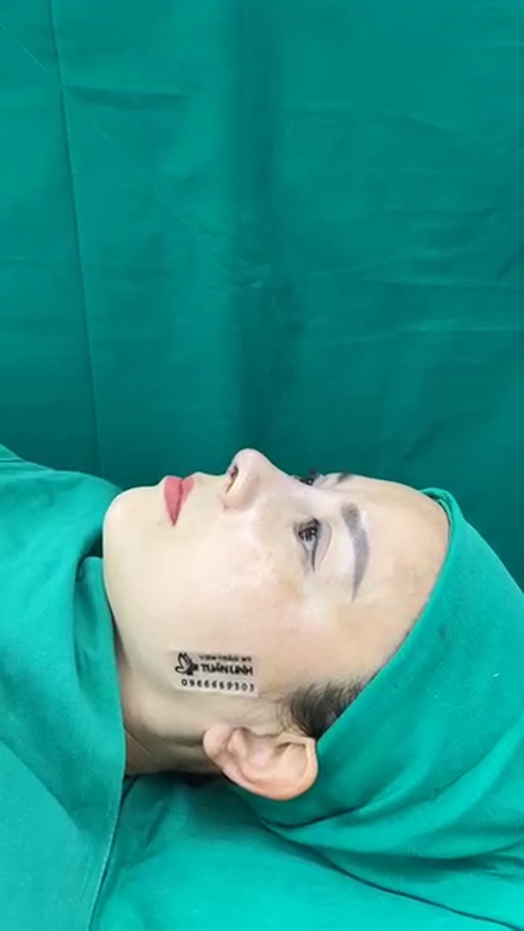 Case mũi Siêu cấu trúc sửa lại sụn surgiform cho chị gái đến từ Long An