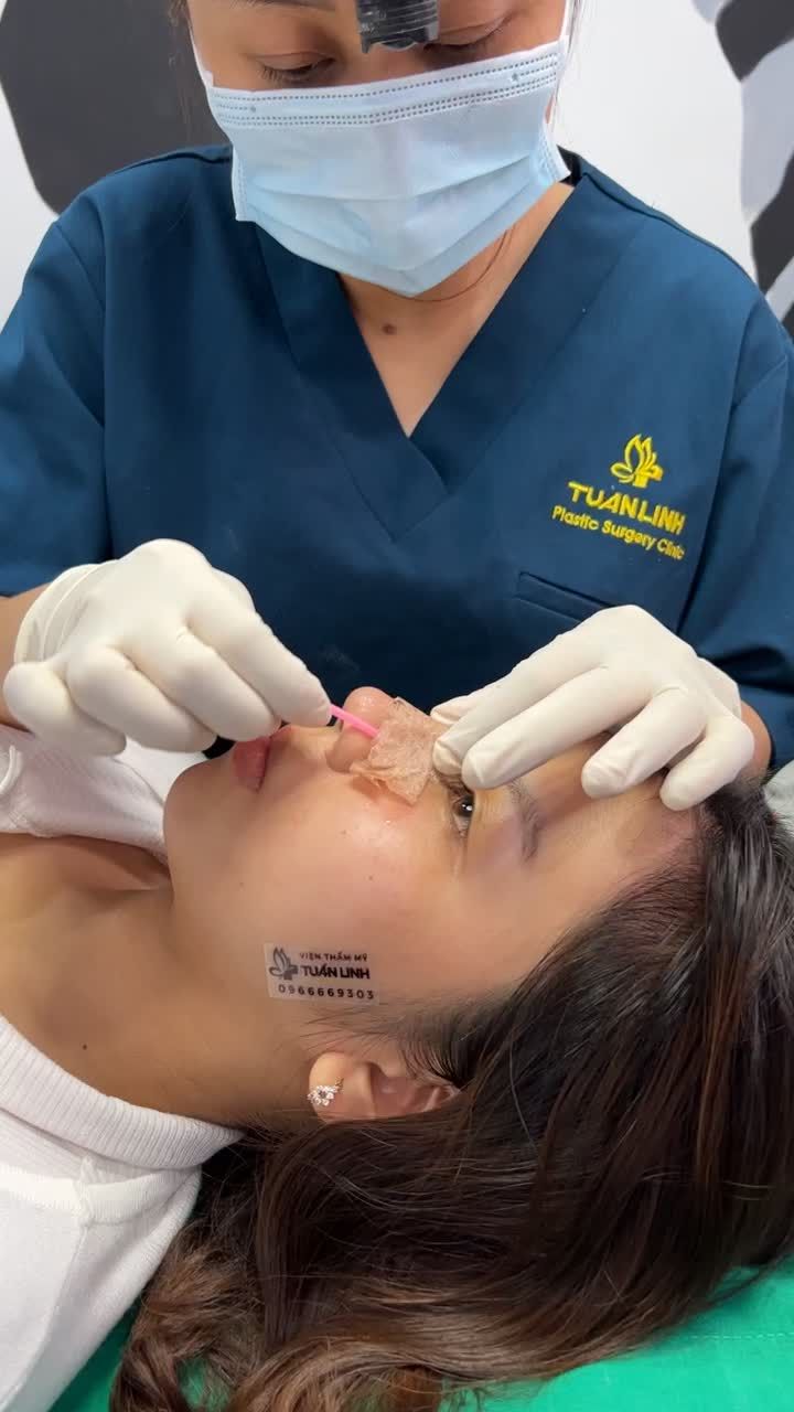 Dáng mũi bọc sụn sau 10 ngày của bạn gái đến từ Tiền Giang