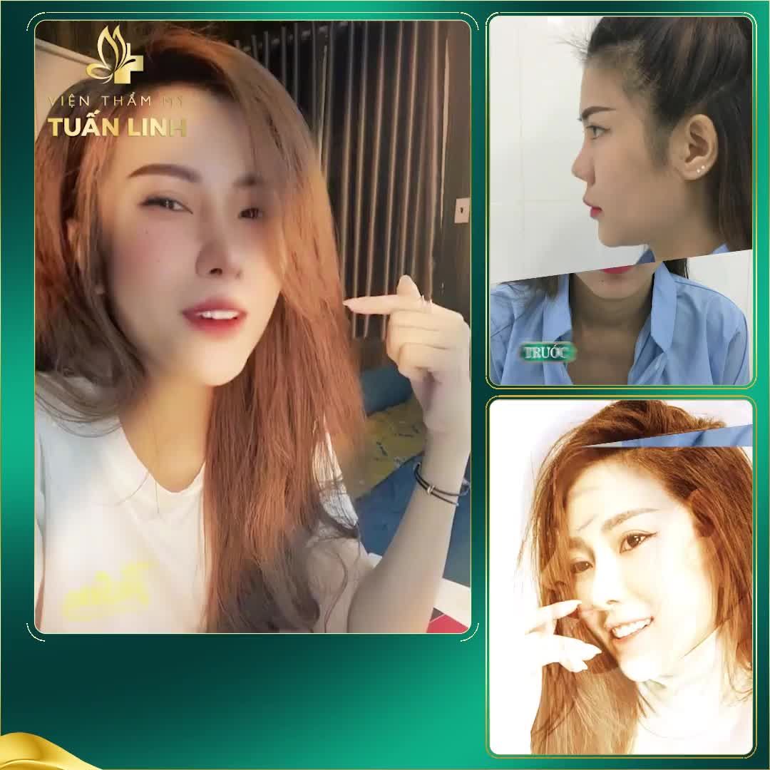 Nâng mũi cấu trúc - Dáng mũi sau 2 năm