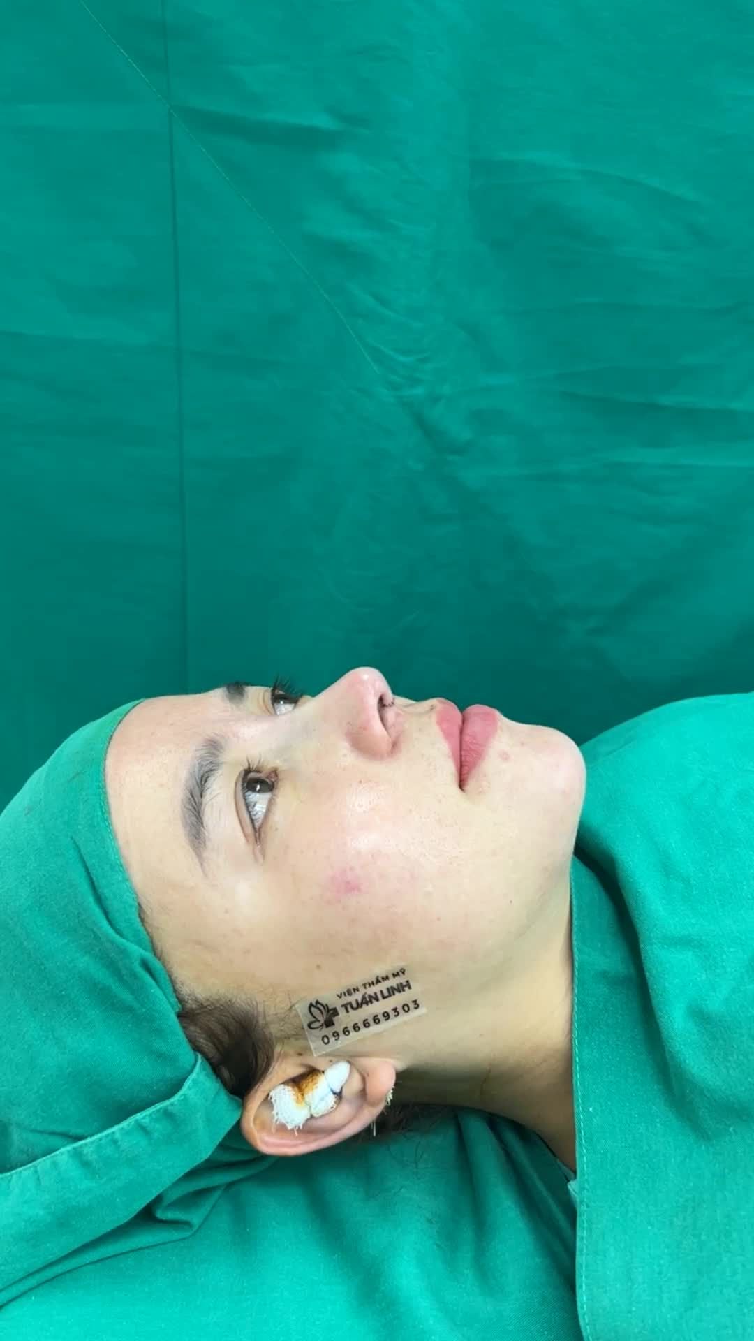COMBO Nâng mũi + Độn cằm giúp khuôn mặt đẹp chuẩn tỉ lệ vàng cho cô gái đến từ Đà Lạt.