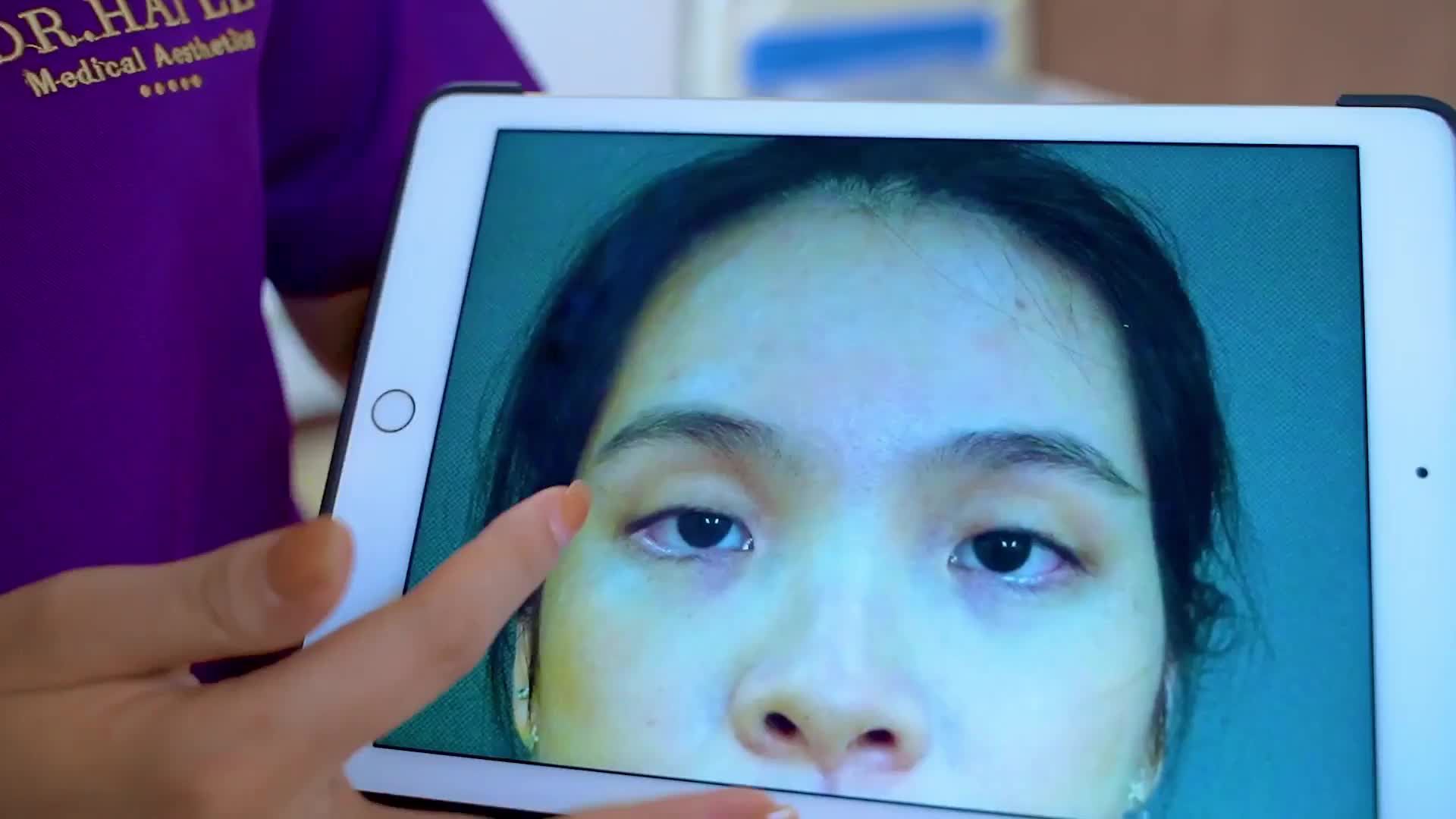 Nhược cơ nâng mi gây sụp mí bẩm sinh có khắc phục được không