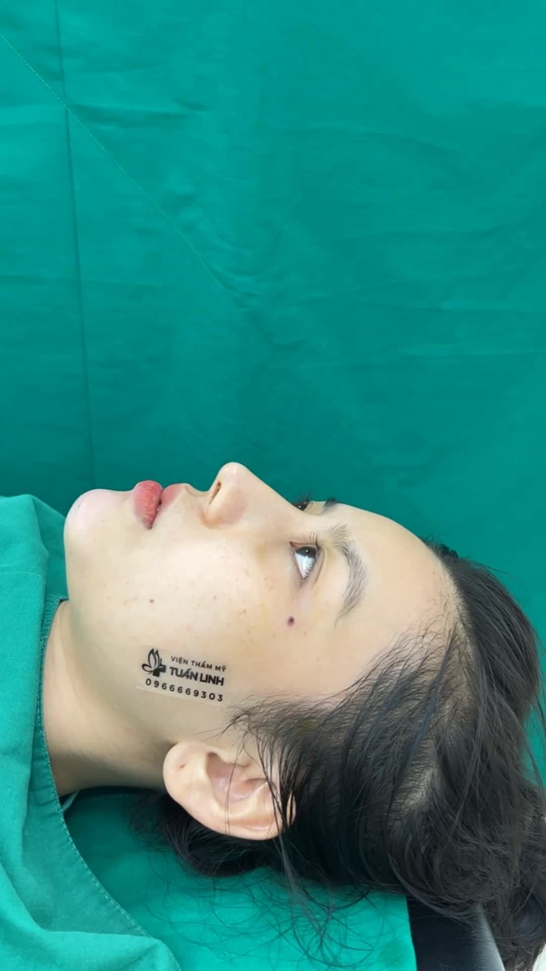 Case độn cằm cho khách hàng cũ đã từng nâng mũi tại Viện. Các bạn cùng xem dáng cằm vừa hoàn thành nhé
