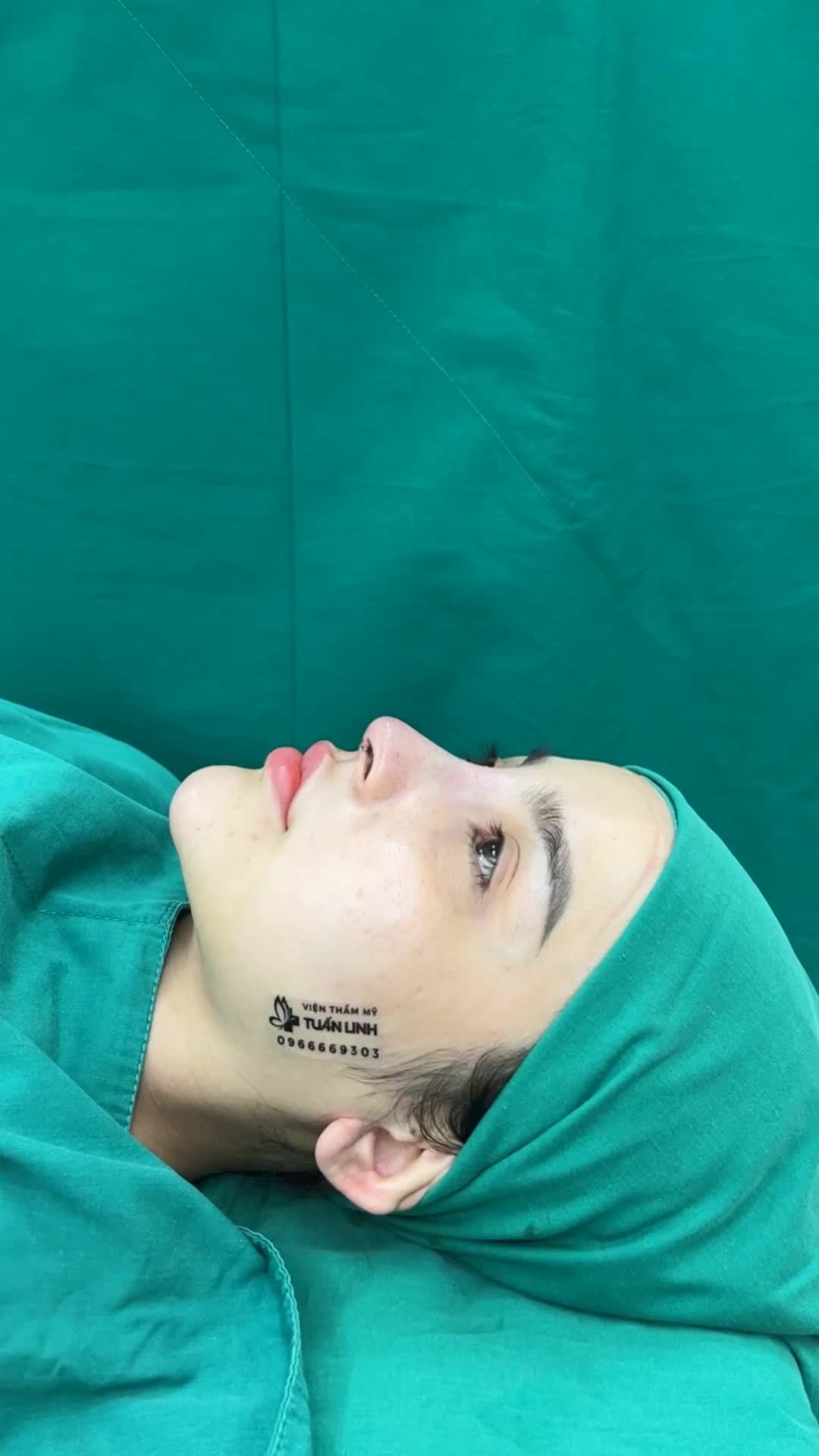Case mũi cấu trúc sụn Mỹ bọc Megaderm toàn sóng vừa hoàn thành