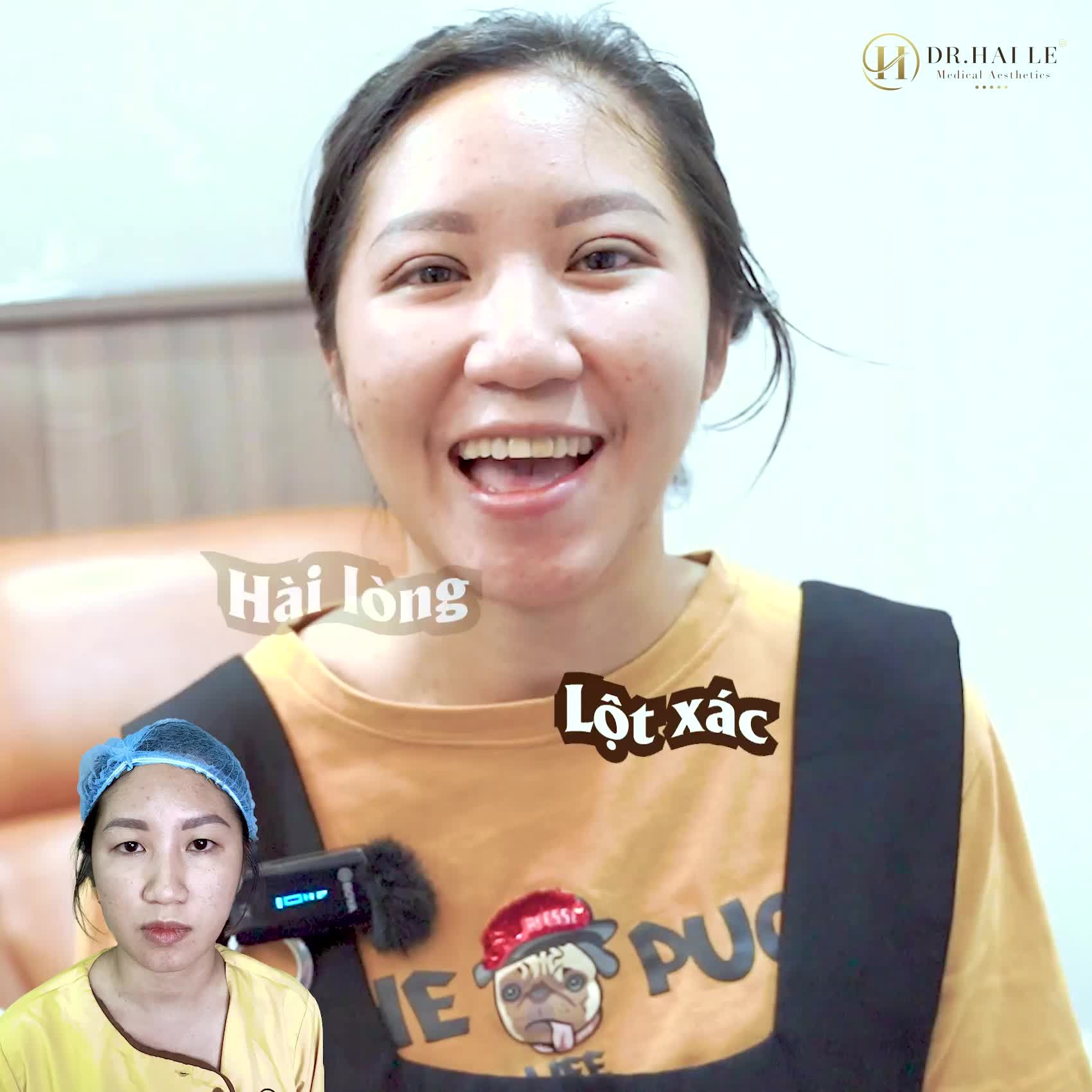 Lí do nàng ấy chọn cắt mí tại Dr.Hải Lê - Sài gòn