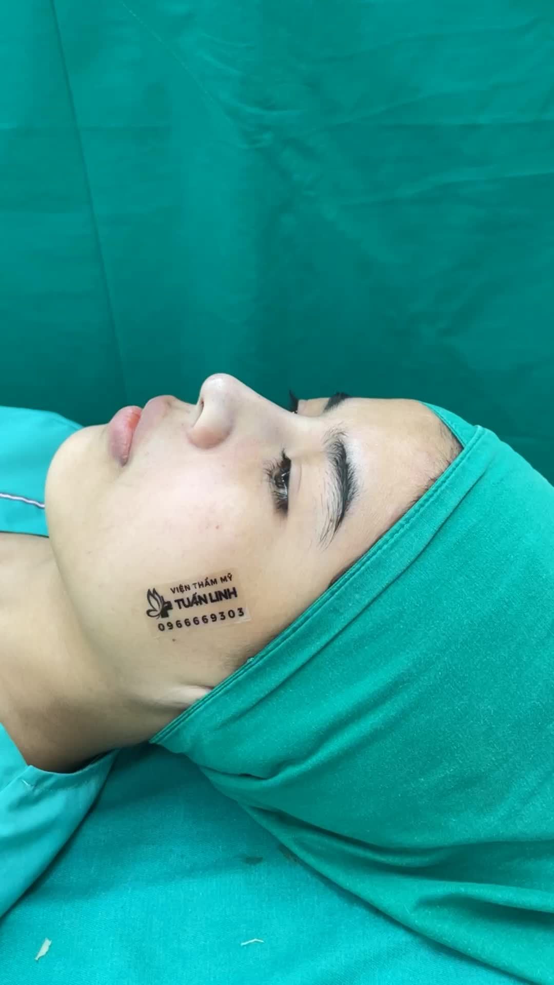 Khắc phục đầu mũi to ngắn, sống mũi có gồ nhẹ cho em gái đến từ Bình Thuận