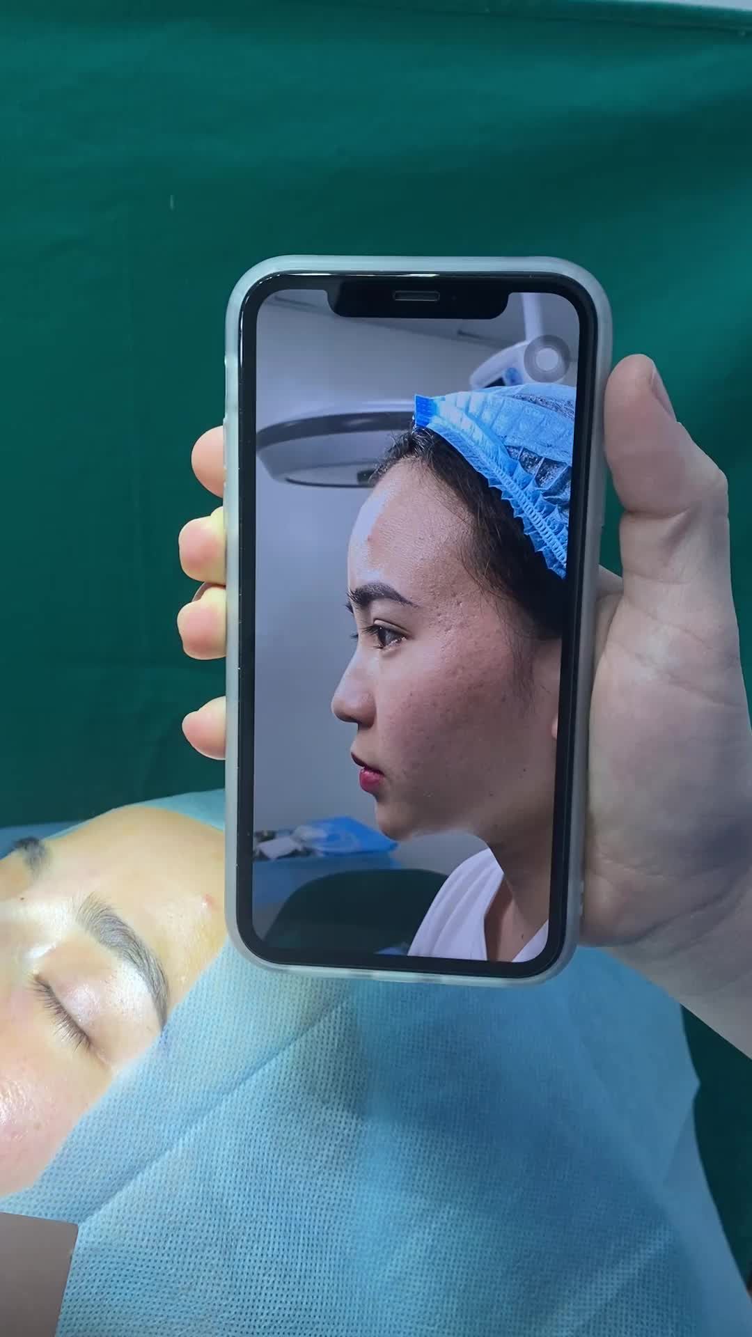 Ca mũi Surgiform bác sĩ vừa hoàn thành xong cho khách hàng