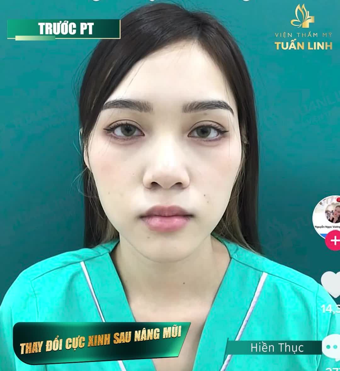 NÂNG MŨI SẼ THAY ĐỔI KHUÔN MẶT BẠN NHƯ THẾ NÀO