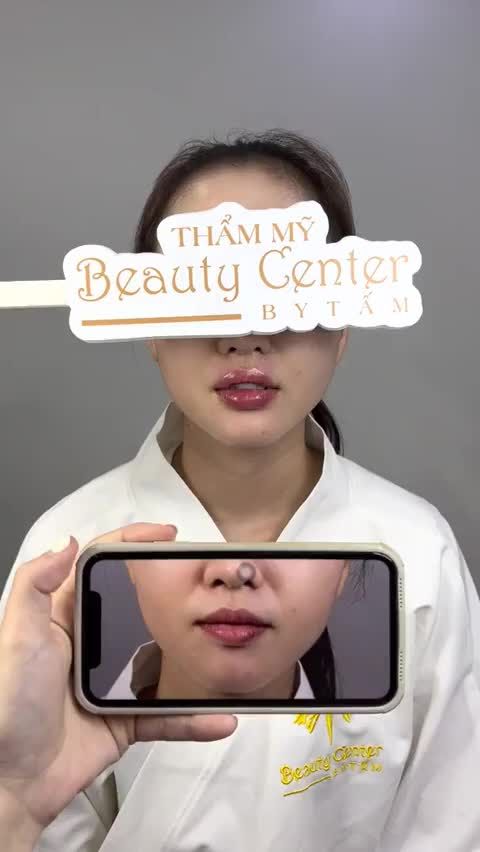 Cận cảnh ca filler môi cho bạn khách hàng gặp tình trạng môi lệch, hai môi không cân nhau. Cùng Tấm xem kết quả sau làm nhé!