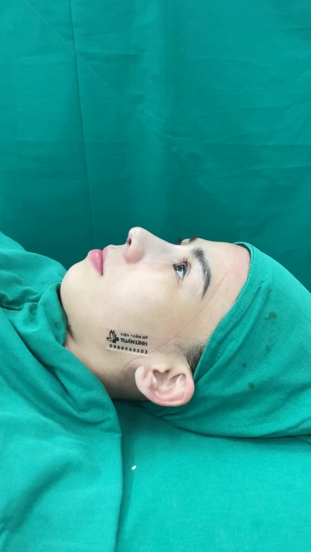 Lên dáng mũi cao thanh tú cho cô gái có sống mũi  thấp tẹt, cánh mũi to bè.