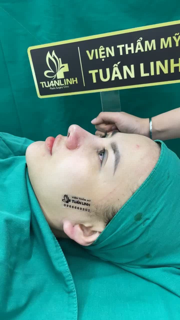 Tái tạo dáng mũi mới đẹp hoàn hảo cho cô gái đã từng nâng mũi Hàn Quốc cách đây 8 năm