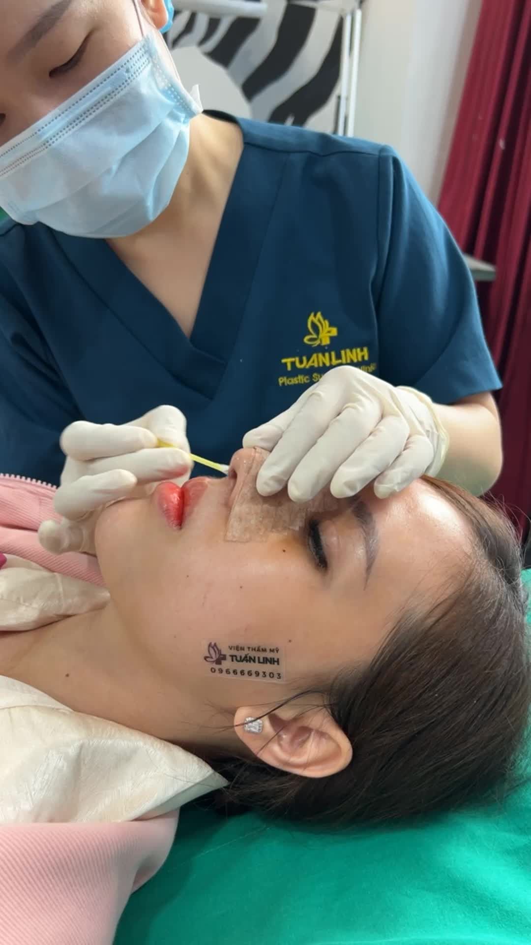 Khách hàng thay nẹp, vệ sinh vết thương sau 5 ngày nâng mũi cấu trúc Surgiform