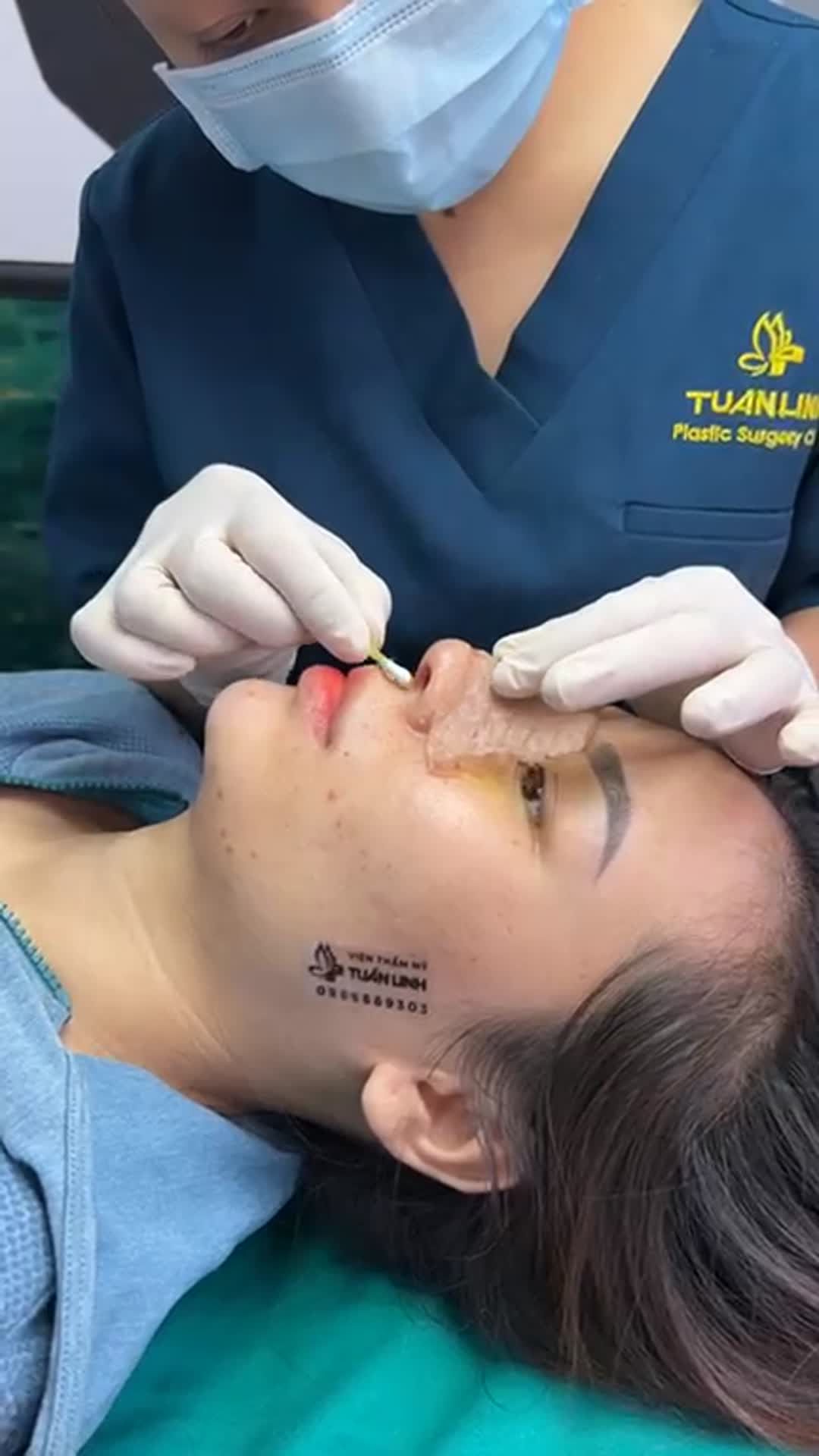 Nâng mũi cấu trúc - Tái khám, tháo naepj sau 10 ngày