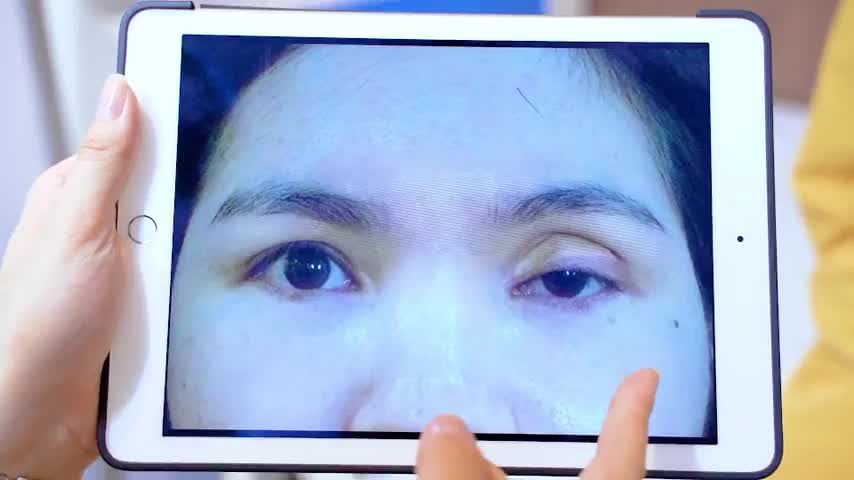 Dr.Hải Lê giải cứu mọi ca mí lỗi hỏng do phẫu thuật thẩm mỹ, do tai nạn, do sụp bẩm sinh sửa nhưng chưa thành công...