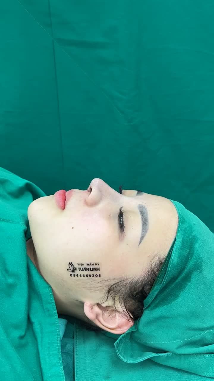 Mê mẩn dáng mũi ANGEL LINE cao tây vừa hoàn thành sau 90 phút
