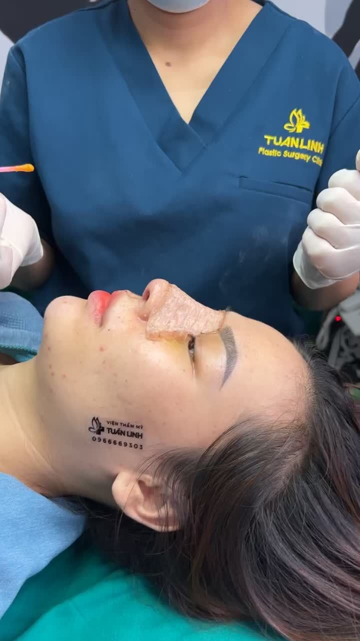 Nâng mũi cấu trúc - tái khám, tháo nẹp sau 10 ngày
