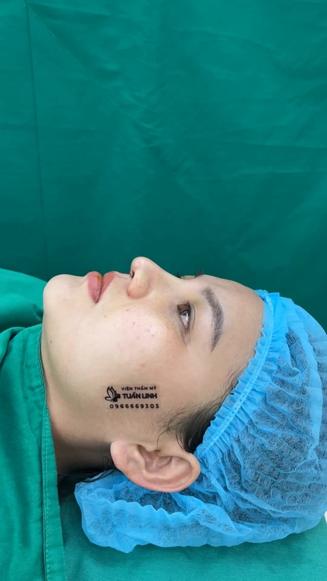 Case Nâng mũi siêu cấu trúc surgiform cho chị gái đến từ Đà Nẵng