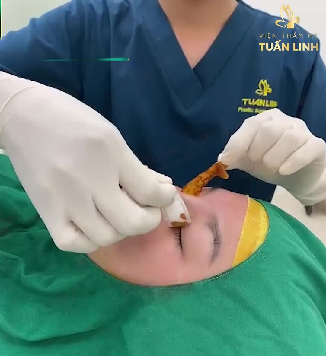 NÂNG MŨI BÁN CẤU TRÚC - DÁNG MŨI TỰ NHIÊN HÀI HÒA