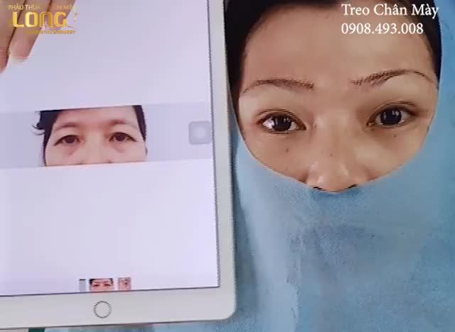 AI ĐANG GẶP TRÌNH TRẠNG MẮT DA DƯ, SỤP MÍ VÀO XEM NGAY Cứu đôi mắt lão hóa cho cô khách