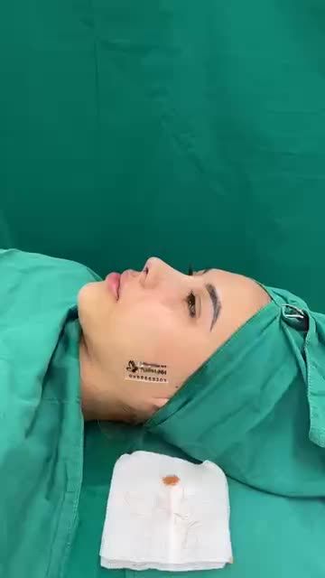 Tái tạo dáng mũi mới cho khách hàng đã từng nâng mũi chỉ