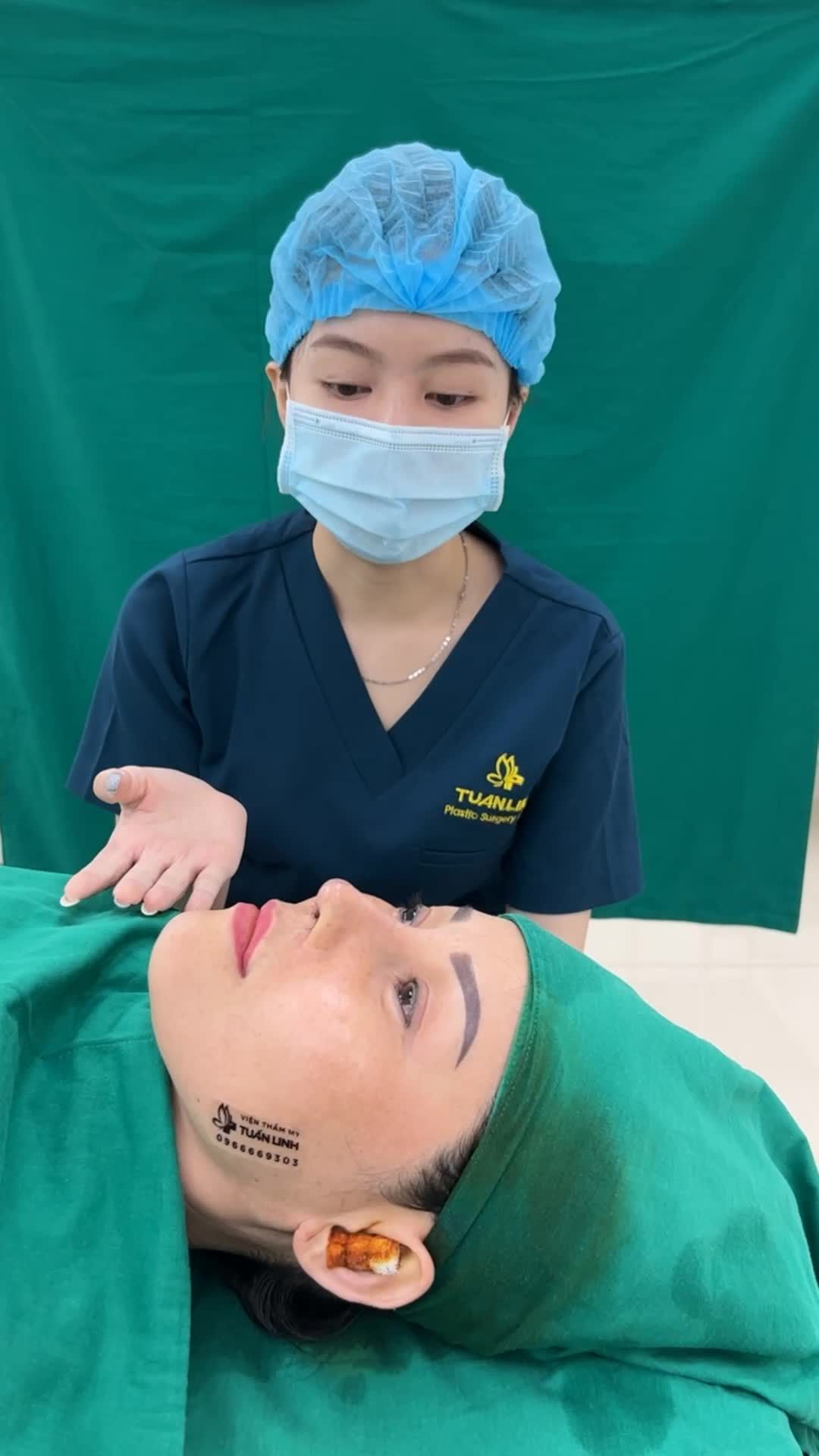 Case Nâng mũi siêu cấu trúc sửa lại sử dụng sụn surgiform + bọc megaderm đầu mũi hoàn thành sau 90 phút