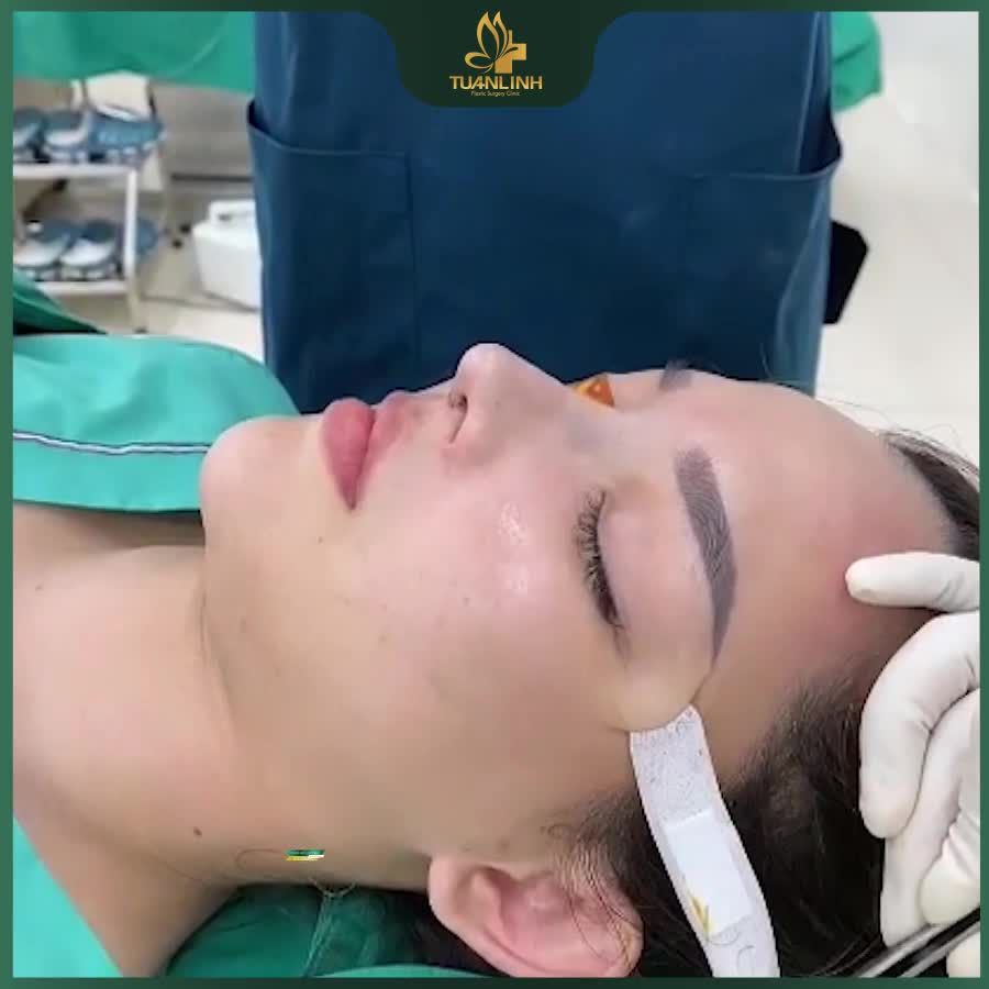Nâng mũi siêu cấu trúc - Đỉnh cao trong tạo hình dáng mũi theo mong muốn