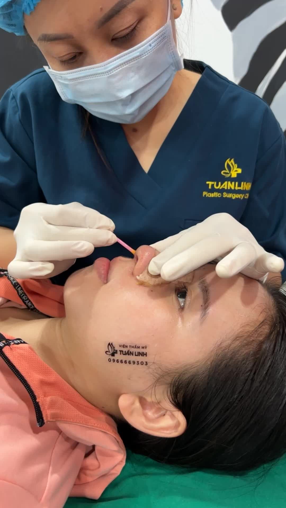 Kết quả nâng mũi cấu trúc Surgiform 10 ngày cho bạn gái thích nhẹ nhàng tự nhiên