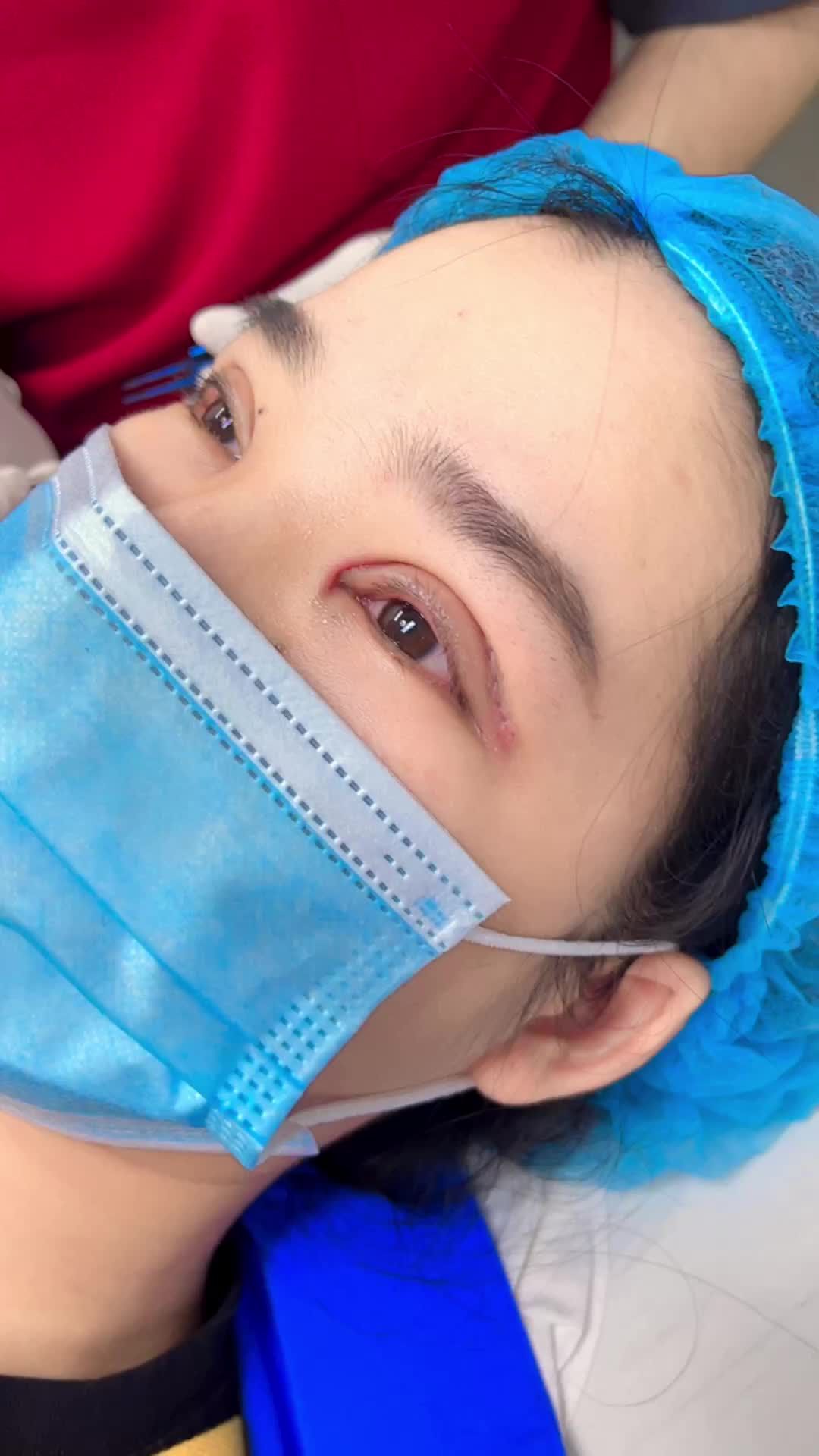 Kết quả cắt mí Plasma sau 5 ngày phẫu thuật tại Kanganm