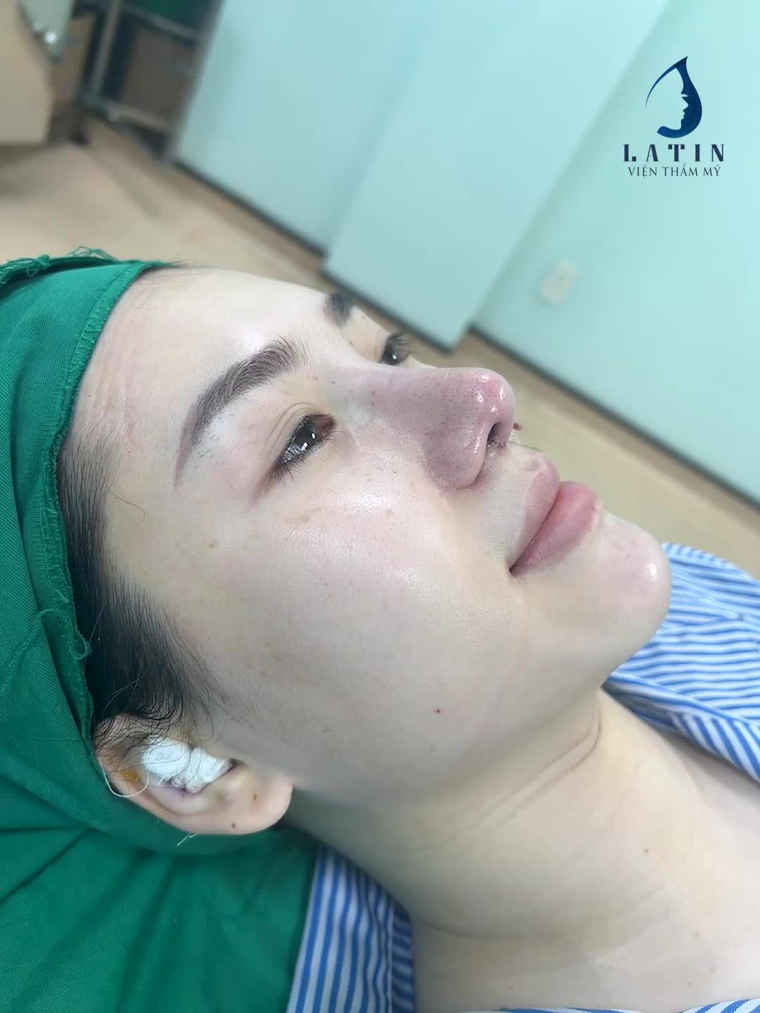 Hình ảnh ca sửa mũi cấu trúc thành công cho khách hàng là mẹ bỉm sữa