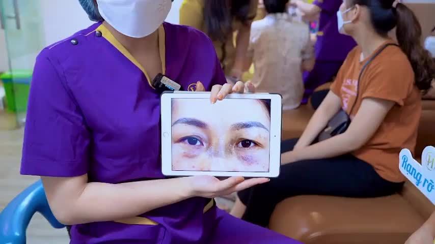Nâng cung mày có thể khắc phục tình trạng sụp mí già nua, nặng mắt, che khuất ở tuổi trung niên hiệu quả như thế nào