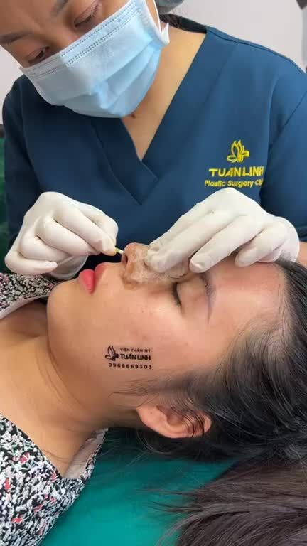 Tháo nẹp + Tái khám sau 10 ngày nâng mũi cấu trúc sụn sinh học Mỹ