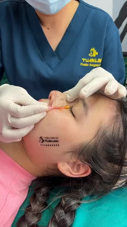 Mũi cao xinh tự nhiên sau 10 ngày nâng mũi cấu trúc