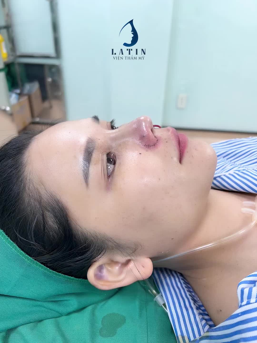 Mũi bán cấu trúc chỉnh hình nền, đầu mũi và cánh mũi