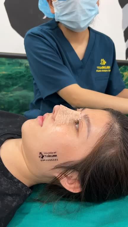 NÂNG MŨI CẤU TRÚC SAU 10 NGÀY – CHUẨN DÁNG MŨI XINH CHO NÀNG TỎA SÁNG
