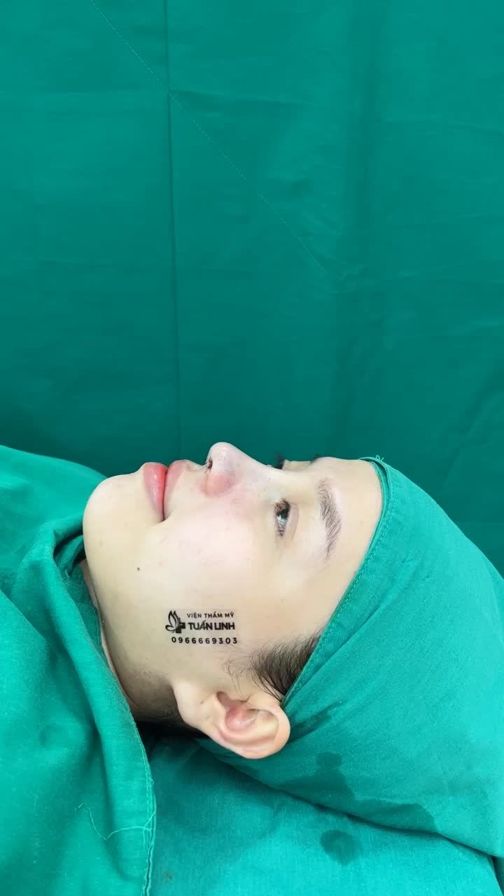 Case Nâng mũi cấu trúc bọc megaderm toàn sóng hoàn thành sau 90 phút.