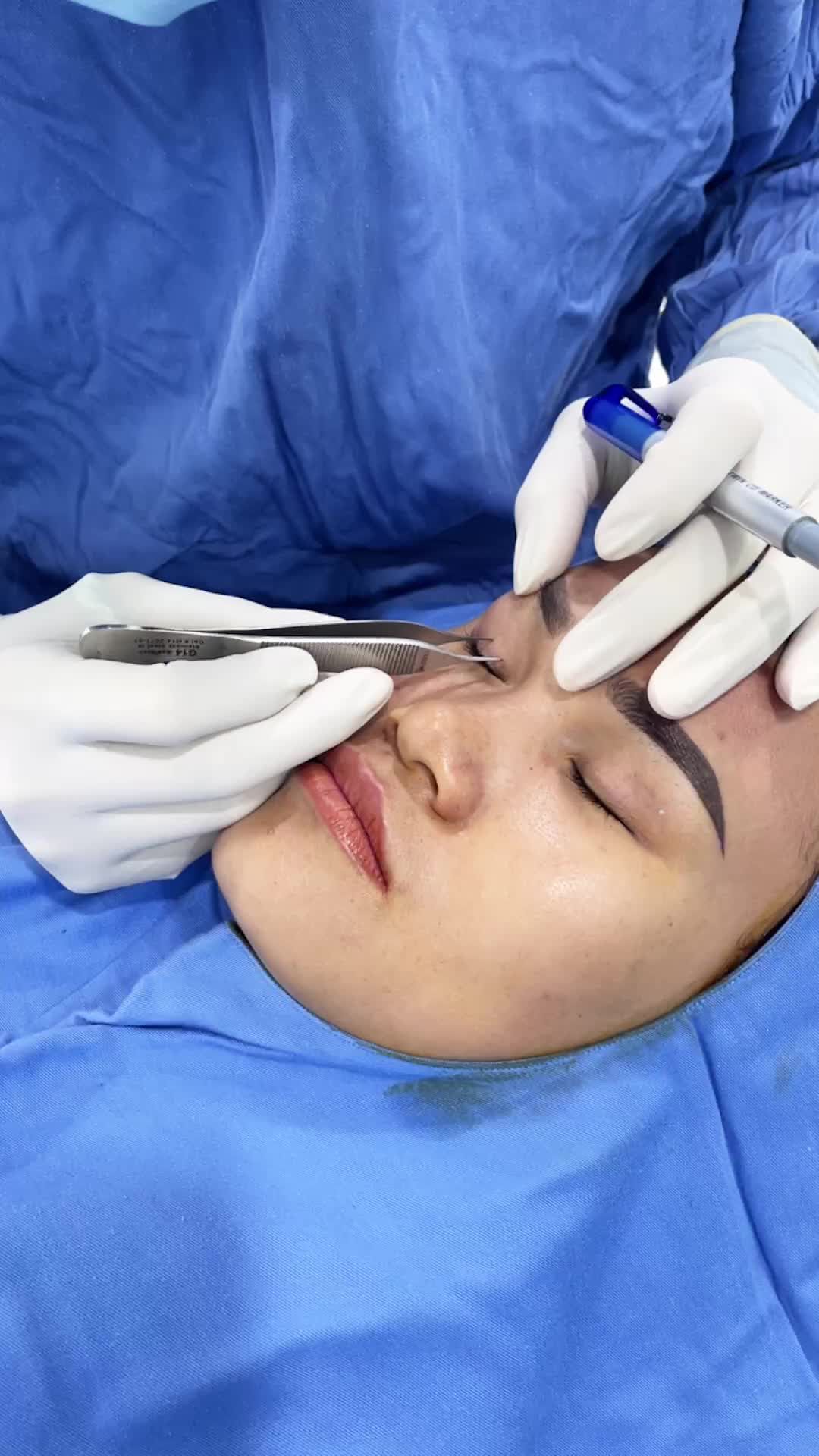 Bác sĩ phân tích cắt mí trên Plasma - tạo nếp mí đều chuẩn Hàn Quốc