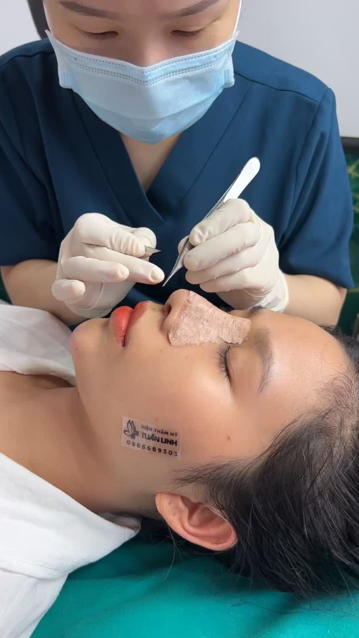 Tháo nẹp sau 10 ngày nâng mũi siêu cấu trúc sụn Surgiform