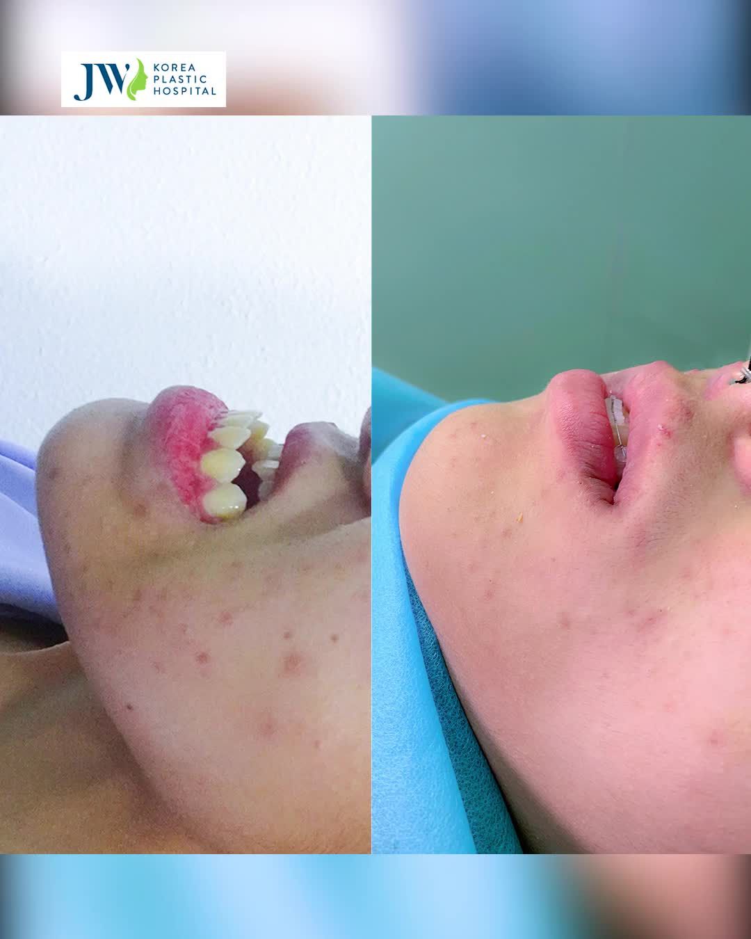 Bác sĩ JW PHẪU THUẬT HÀM MÓM thế nào mà cô gái MẶT LỆCH 20 năm SỐC TẬN ÓC vì ĐẸP HẾT CHỖ CHÊ !