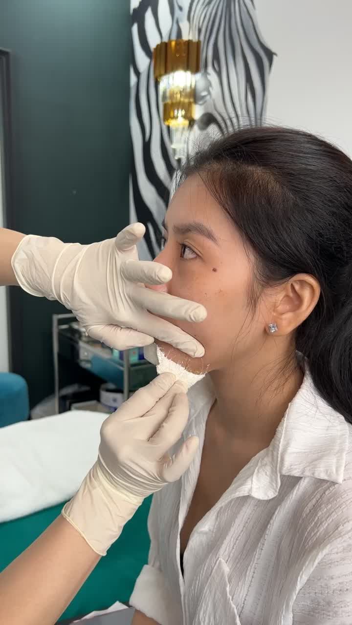 ĐỘN CẰM PLASMA - VÀO PHOM CHUẨN ĐẸP SAU 7 NGÀY THÁO NẸP